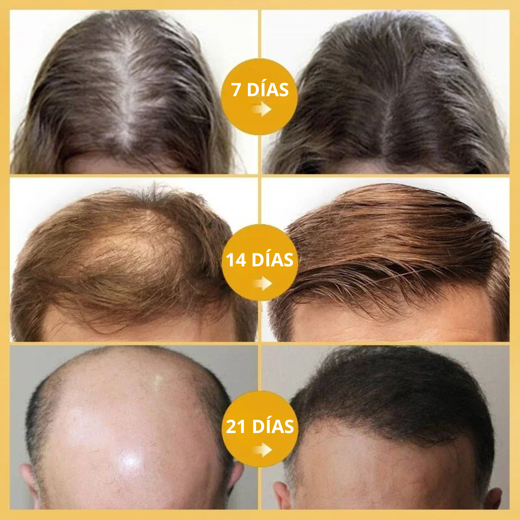 King Of Ginger® Spray Tónico Capilar para Crecimiento en 7 Días- Para Hombres y Mujeres (Pague 2 y Lleva 3)